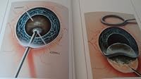 Supersight the Lens Implant Miracle 0993801013 Book Cover