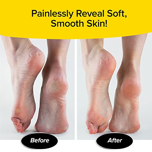 image for PedEgg Classic Callus Remover, As Seen On TV, New Look, Safely and Pai