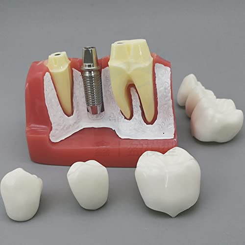 Modèle d'implant dentaire 4x avec couronne amovible pour démonstration - 2