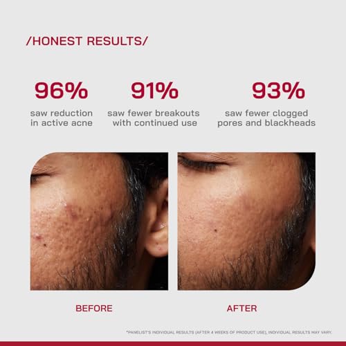 Image of /PHD / 2% Salicylic Acid Anti-Acne Serum | Salicylic Acid Face Serum for Acne-Prone & Oily Skin | Pore Minimizing serum with Niacinamide & Peptides |Reduces Blackheads & Excess Oil | Men & Women I30 ml