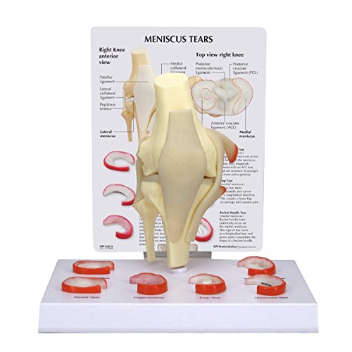 GPI Anatomicals Modelo de rodilla, menisco con 6 desgarros