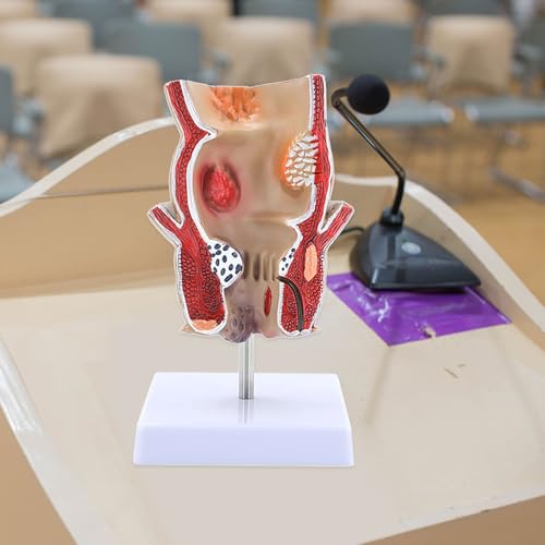 Modèle rectum humain pour l'anatomie et l'explication clinique - 5
