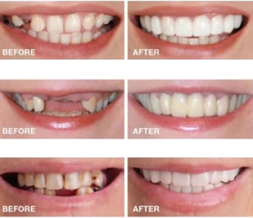 Image of Adjustable,Nature and Comfortable,Regain Confident Smile