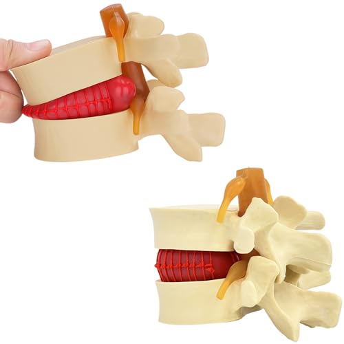 Image of Human Anatomical Lumbar Herniation Model with Nerve Root,Anatomical Vertebrae Model for Education,Excellent Way for Demonstrating Disc(Yellow)