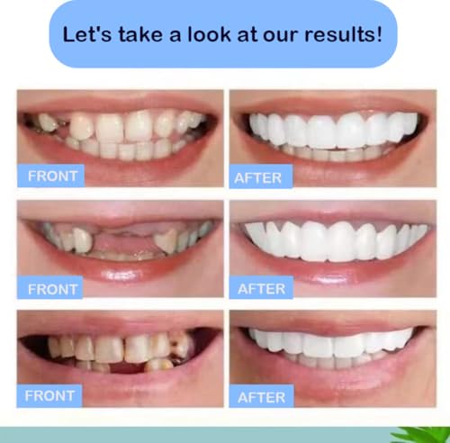 Image of Teeth Whitening and Restoration Kit for Covering Stains and Repairing Damaged Teeth, 2 Pieces