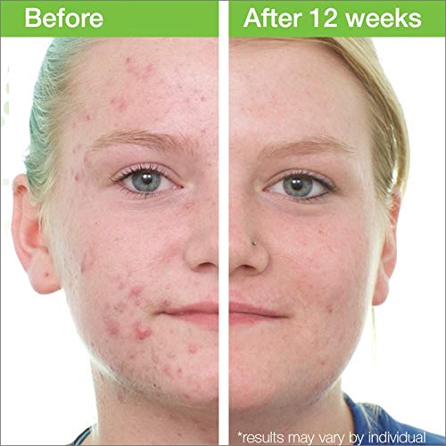 Miniatura 6 de MD Complete Acne Clearing Duo Step 1 - Limpiador de ácido salicílico 2.0% 3.0 onzas líquidas + paso 2 peróxido de benzoilo 4.5% tratamiento de