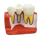 opción ideal - nuestro modelo de diente de demostración transversal es ideal para la práctica dental para demostraciones de pacientes y demostraciones legales.