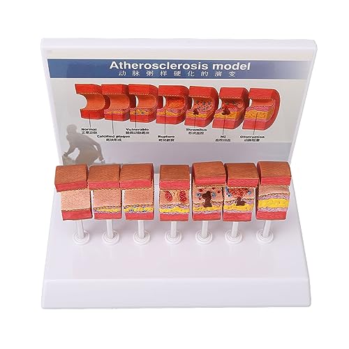 Anatomy Replica Model, Atherosclerosis Human Body Artery Model Bright Colors Simulation Ecofriendly...