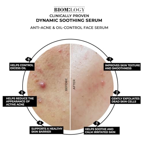 Image of Biomlogy Anti Acne Face Serum 22% Actives with 2% Salicylic Acid, 7% Niacinamide, 2% Ceramide, Prebiotic for Oily & Acne Prone Skin |Controls Excess Oil, Fades Acne Marks, Barrier Care| 10 ML