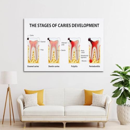 Understanding Tooth Decay Poster - Visual Guide to Dental Caries Development Stages, Educational Wall Decor for Clinic(Framed,12x18inch(30x45cm)) [4]