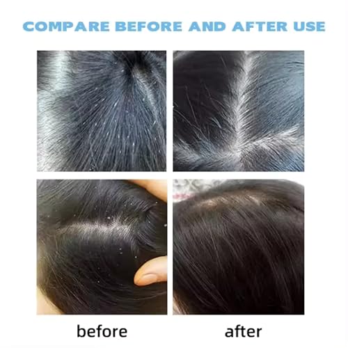 Image of Natural Anti Lice & Nits Remover Shampoo with Rosemary, Tea Tree & Neem Oil | Gentle Lice Treatment for Kids & Adults | Removes Lice & Nits, Cleanses & Protects Hair | Free Lice Comb | SLS & Parabeen Free | (Pack of 2)(200 ml Each)