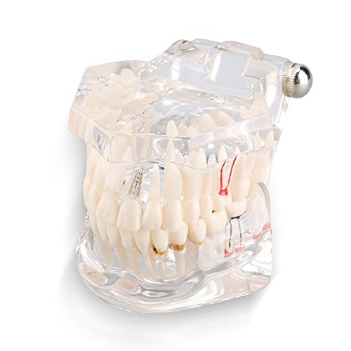 Removable Adult Teeth Study Dental Pathological Disease Implant Teaching Typodont Model - Dentist Standard