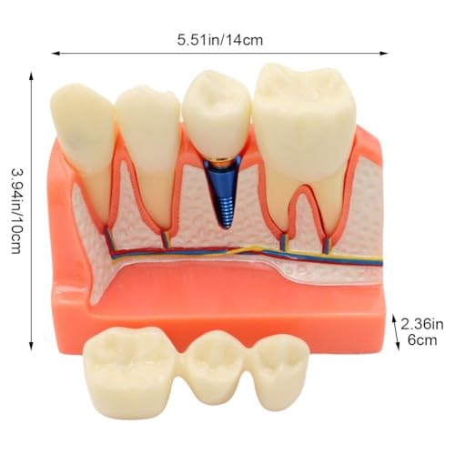 Modèle d'implant dentaire pour résoudre les erreurs d'analyse de pont - 8
