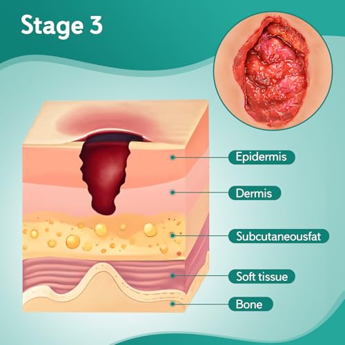 Image of Decubitus Ulcer Care Model, Bedsores Model, Pressure Injury Model for Medical Training Practice, Stage 3