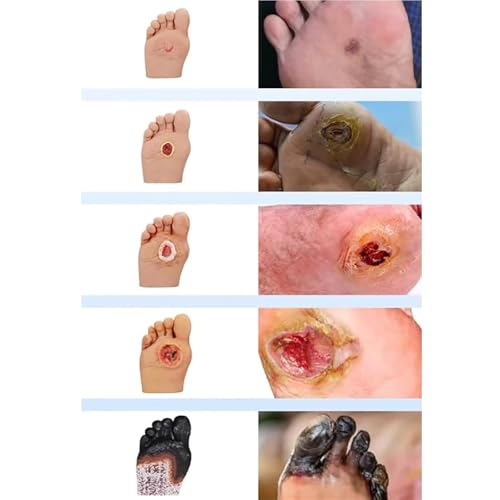 Model symulatora pielęgnacji stóp cukrzycowych – ropne zmiany ran stopnia 1-5 do anatomii, fizjologii i demonstracji pielęgnacji ran