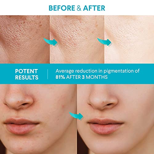 Healpool Rapid Dark Spot Remover For Face And Body - Dark Spot Corrector & Face Lightening And Brightening Serum -(1.7 Fl Oz) #TOP1