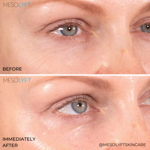 Mesolyft Combo de pescoço e olhos para cuidados com a pele, soro sob os olhos com removedor de linha