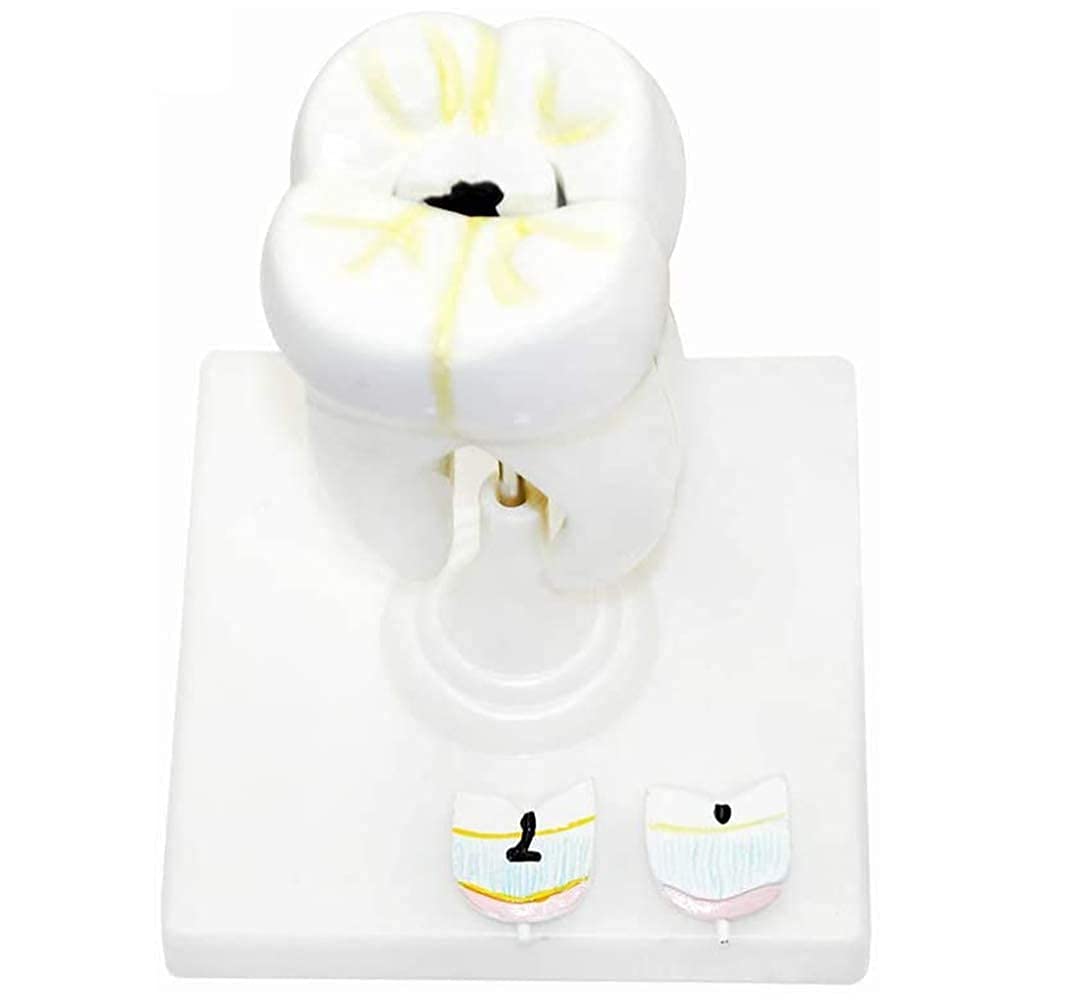 ERNZI Modèle Anatomique, Modèle Dentaire, Traitement Biomédical Enseignement De L'anatomie Dentaire Humaine, Modèle De Carie Molaire, Modèle D'enseignement Standard Axé sur La Recherche
