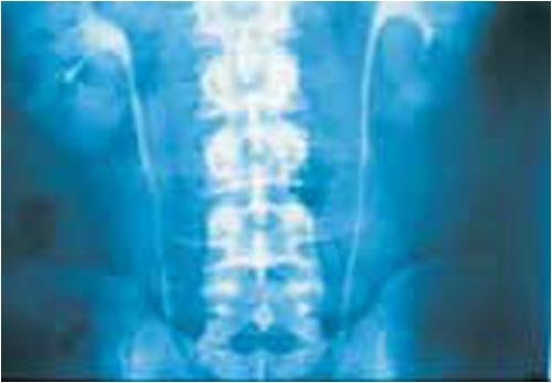 Radiation by Bill Stonebarger