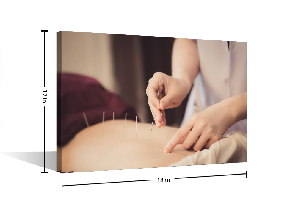 Image of Wall Painting Acupuncture and Moxibustion Paintings for Wall Decorations 1 Panels Physical Therapists do Acupuncture Wall Art Giclee Wooden Framed Gallery-Wrapped Ready to Hang (12 inch Wx18 H)