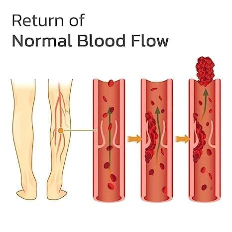 Varicose Veins Patches Dredge Vein Smoothing Veins Reduce Swelling Relieve Pain Instant Relief from Muscular Pain Improve Blood Circulation (1) Varicose Veins Patches Dredge Vein Smoothing Veins Reduce Swelling Relieve Pain Instant Relief from Muscular Pain Improve Blood Circulation (1)