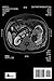 The Kidney Stone That Wasn't: A Personal Journey Through The Diagnosis & Treatment of Renal Cancer