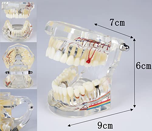 YOUYA DENTAL Modèle dentaire de réparation neurale - Modèle dentaire - Modèle d'implant - Modèle dentaire standard - Modèle d'enseignement des dents pathologiques amovibles pour les dentistes – vue 7