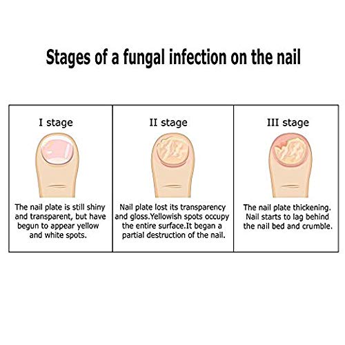 Nail Fungus Cream,Fungus Stop,Foot Fungus,Anti fungal Nail,Fungus Treatment Cream,Foot & Nail Fungus Treatment,Effective Against Nail Fungus,Repair and Protect Nails (20g) - Thumbnail 2