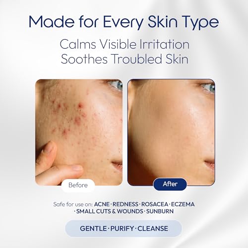 Image of e11ement Hypochlorous Acid Spray for Skin, HOCl Facial Mist & Body Spray, Skin Cleanser for Face, Acne Prone & Sensitive Skin, Fragrance Free, All Skin Types & All Ages (8 oz)
