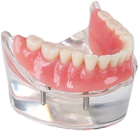 SOARDAY Dental Restoration Model with 4 implants Overdenture Inferior Teaching Study Teeth Model