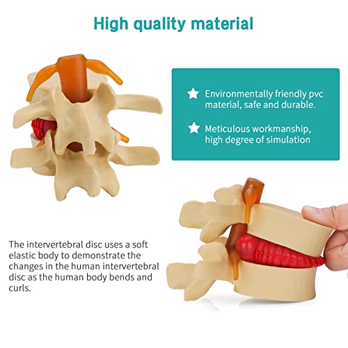 Image of Disc Herniation Model - Human Lumbar Disc Herniation Spine Model 1.5X Intervertebral Disc Model Anatomical Vertebrae Disc Model with Elastic Software