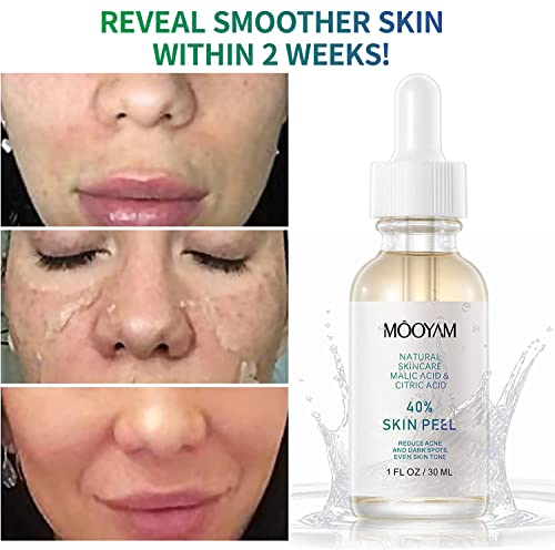 40% Citric Acid Peeling Serum, Chemical Peel For Face, Peeling Solution Skin Peel, Chemical Exfoliant For Face, Exfoliating Facial Peel For Dark Skin, Dark Spots, Acne Spot - 30Ml/1 Fl Oz #TOP1