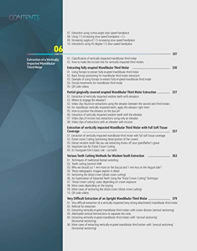 Extraction of Third Molars : Easy Simple Safe Efficient Minimally Invasive & Atraumatic