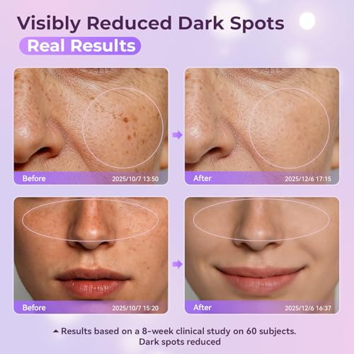 LGUYO Dark Spot Remover for Face & Body - Effective Remedy for Dark Spots & Dark Spot Corrector Cream for Age Spot, Freckles, Melasma, Sun Spot - Even Toning Skin Care for Women and Men - 1.7 Fl Oz