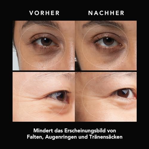 FAQ Microneedling Augenpads gegen Falten & Augenringe mit Hyaluronsäure - Sofortige nicht invasive Ergebnisse - Perfekt für unterwegs - 3×2 Stk.