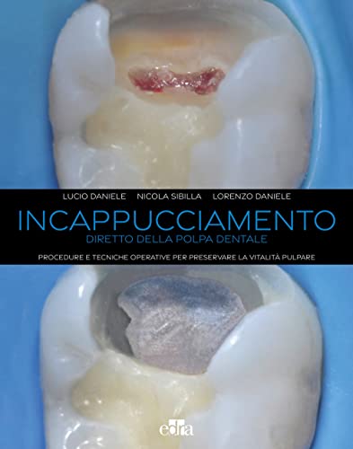 Incappucciamento diretto della polpa dentale. Procedure e tecniche operative per preservare la vitalità pulpare. Con QR code