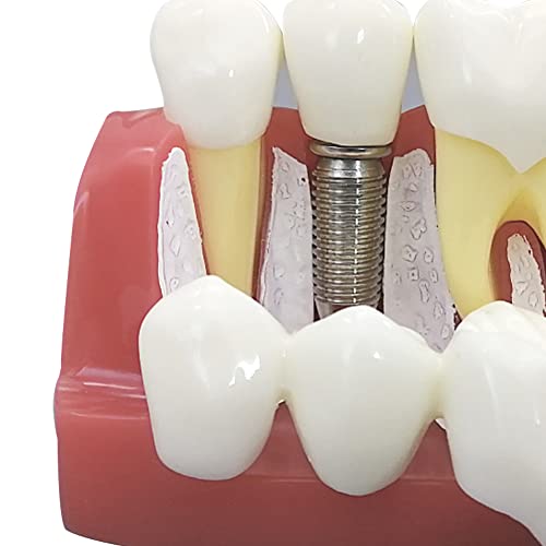 Modèle d'implant dentaire 4x avec couronne amovible pour démonstration - 6