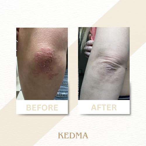 Kedma - Body Butter Gold - Nourishing Body Butter With Shea Butter And Dead Sea Minerals - For Dry And Rough Skin - 200G - 5