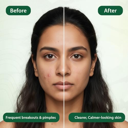 Image of Aryanveda Anti Acne Oil Control Facial Kit for Glowing Skin (260g), Reduces Pimple scars, Controls Sebum Production, Removes Dirt & Grime, All Skin Types Face Pack for Men and Women (6 Units)