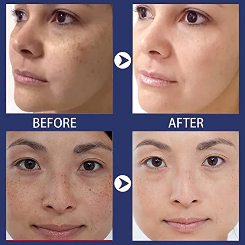 Inlifay Dark Spot Remover Cream - 1.7 Fl Oz - Hyperpigmentation Treatment For All Skin Types - Melasma, Freckles, Sun Spots Correction #TOP5