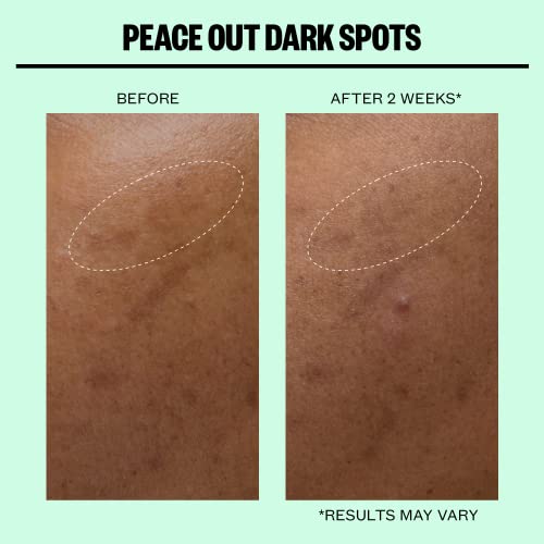 PEACE OUT Skincare Dark Spots, Dissolving Microneedling Dots to Reduce the Appearance of Dark Spots & Hyperpigmentation, Niacinamide Helps Reveal Clear, Even Skin (12 dots)