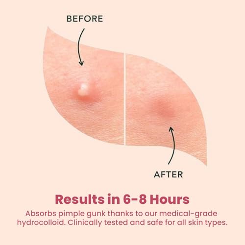 Image of WILDGLOW Korean Hydrocolloid Overnight Acne Pimple Patch | Heal Pimples, Absorbs Pus-Oil, Reduces Redness | Enriched with 2% Salicylic Acid, Tea Tree Oil & Glycolic Acid | All Skin Types | 36 Patches
