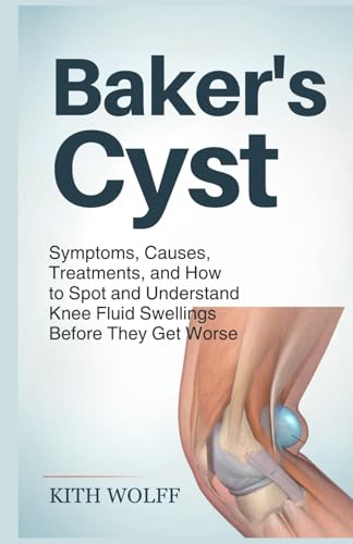 Baker’s Cyst: Symptoms, Causes, Treatments, and How to Spot and Understand Knee Fluid Swellings Before They Get Worse