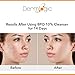 Acne Treatment- 5% Benzoyl Peroxide Face & Body Wash- Penetrates Deep within Pores to Immediately Fight Zits to Clear Skin. Eliminates and Prevents New Pimples from Forming.