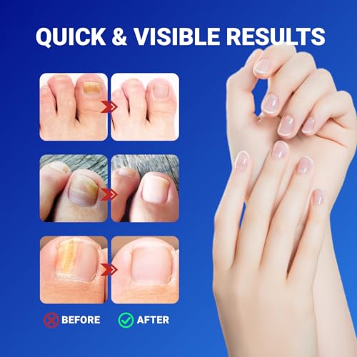 Fungal Nail Patches – 42pcs Hypoallergenic Repair Patches for Damaged, Yellow, or Discolored Toenails – Extra Strength Overnight Support, Mess-Free Formula - Thumbnail 7