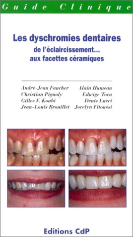 Les Dyschromies Dentaires : De l'éclaircissement... Aux facettes céramiques