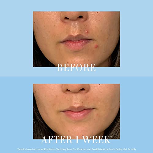 Kate Somerville Eradikate Clarifying Acne Gel Cleanser | Salicylic Acid Acne Treatment Face Wash | Clears Breakouts & Helps Minimize Pores | 4 Fl Oz #TOP3