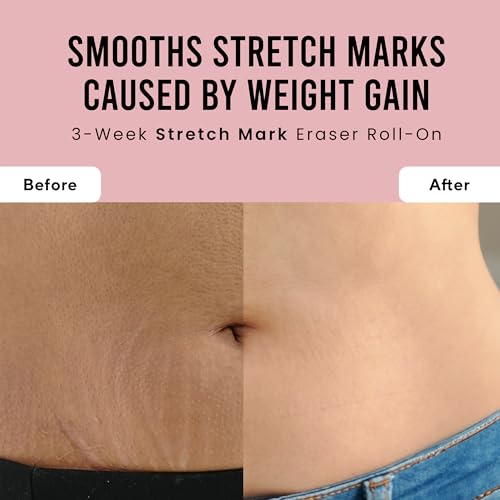Image of Cos-IQ Stretch Marks Removal Roll-On Serum with Striover | Scar Removal | Uneven Skin Tone | All Skin Types | 40ml
