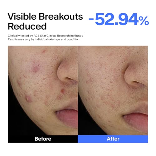 Image of THOME ABC Serum - Azelaic Acid 10% + Niacinamide 5% + Centella Asiatica 1% Triple Synergy Mechanism, Redness Comfort Serum for Dark Spots, Excess Oil & Uneven Texture, Korean Skincare, 1.01 fl oz.