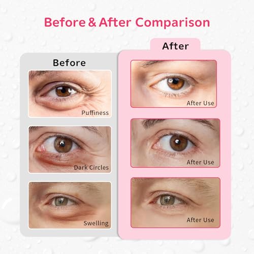 Image of 4PCS Gel Eye Ice Pack Set Reusable, Cold and Hot Compress for Eyes, Ice Pack for Eyes, Cooling Eye Pads for Eye Strain, Swelling, Redness, Dark Circles, Puffy Eyes, and Eye Recovery Surgery.